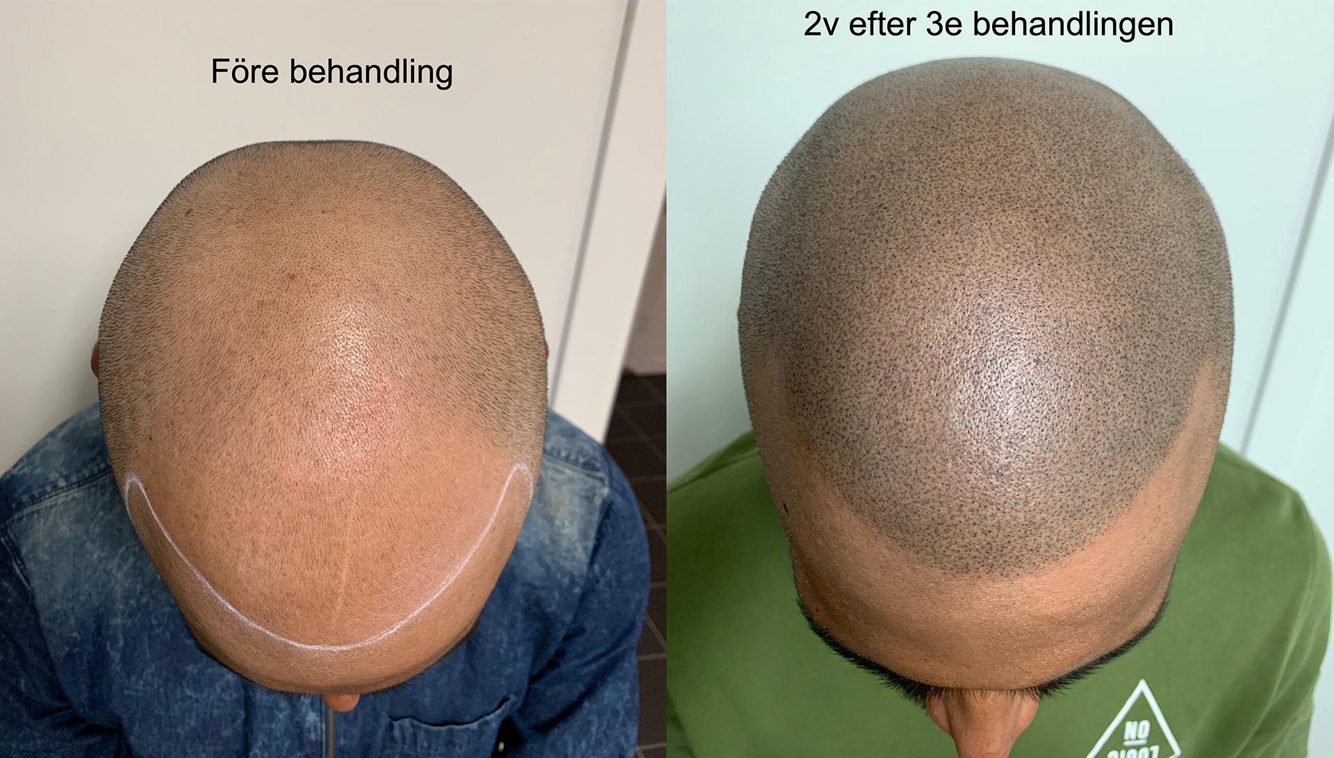 före och efter bilder skalp mikropigmentering - Hårtransplantation-Skalp pigmentering + Galleri