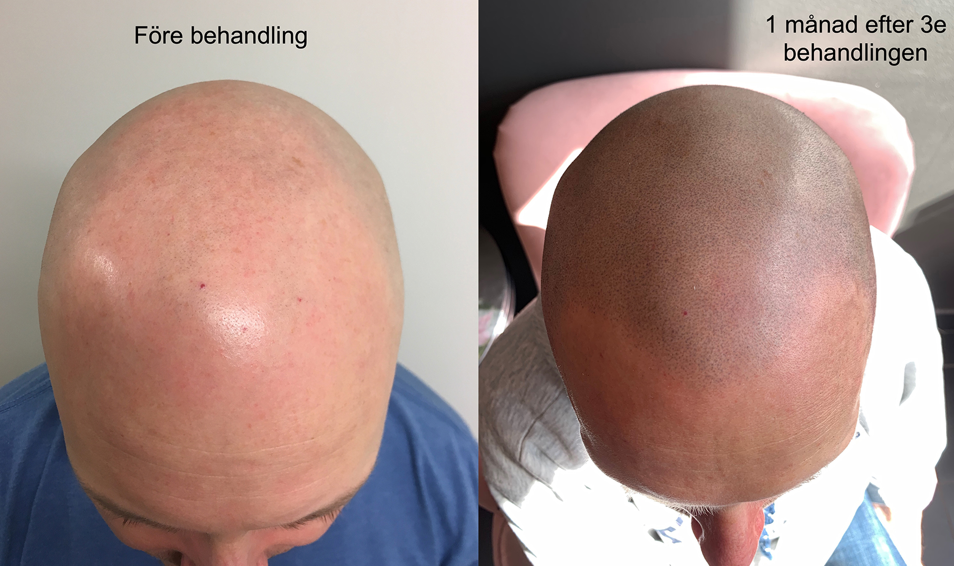 före och efter bilder skalp mikropigmentering - scalp micropigmentation-Framsida + Galleri-