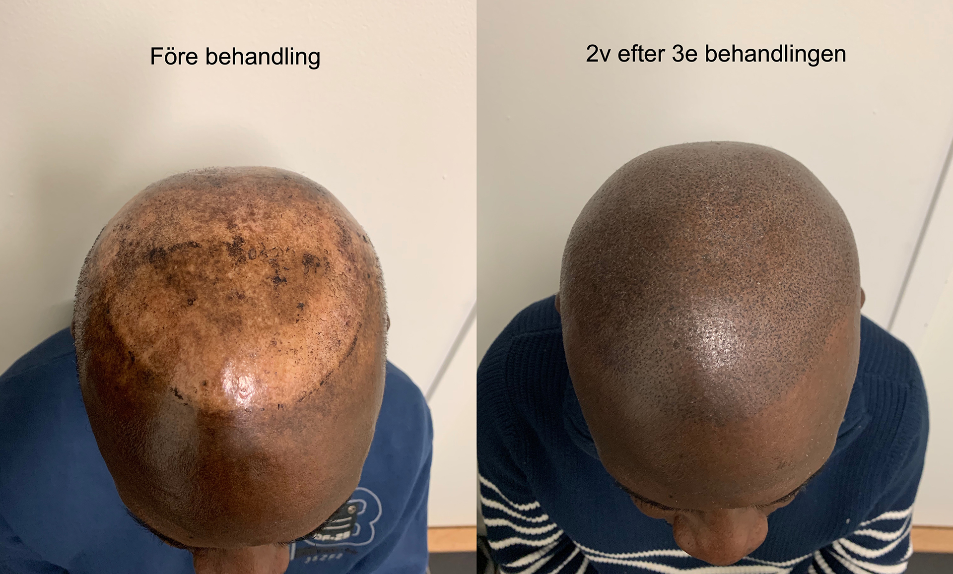 före och efter bilder skalp mikropigmentering - scalp micropigmentation-Framsida + Galleri