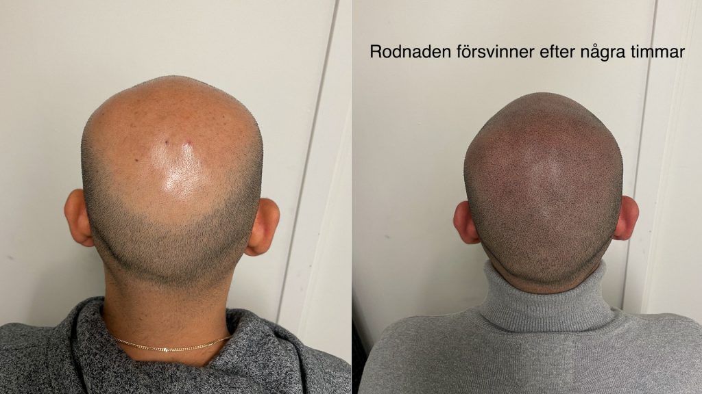 Håravfall behandling - Scalp Micropigmentation Capillos - Stockholm Göteborg Malmö Sverige - 002