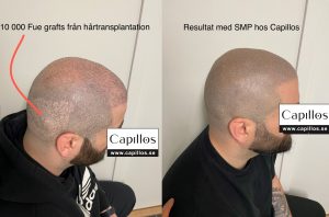 Kamouflera ärr - Scalp Micropigmentation Capillos - Stockholm Göteborg Malmö Sverige - 001