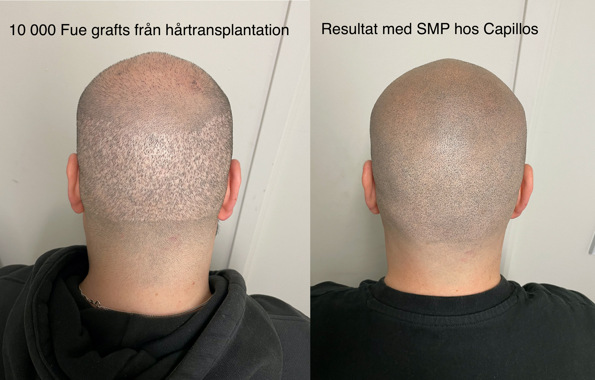 Mikropigmentering ärr - Scalp Micropigmentation Capillos - Stockholm Göteborg Malmö Sverige - 001