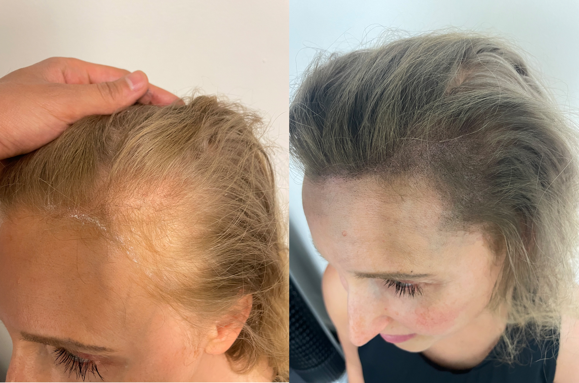 Kvinnligt håravfall - Scalp Micropigmentation Capillos - Linnea