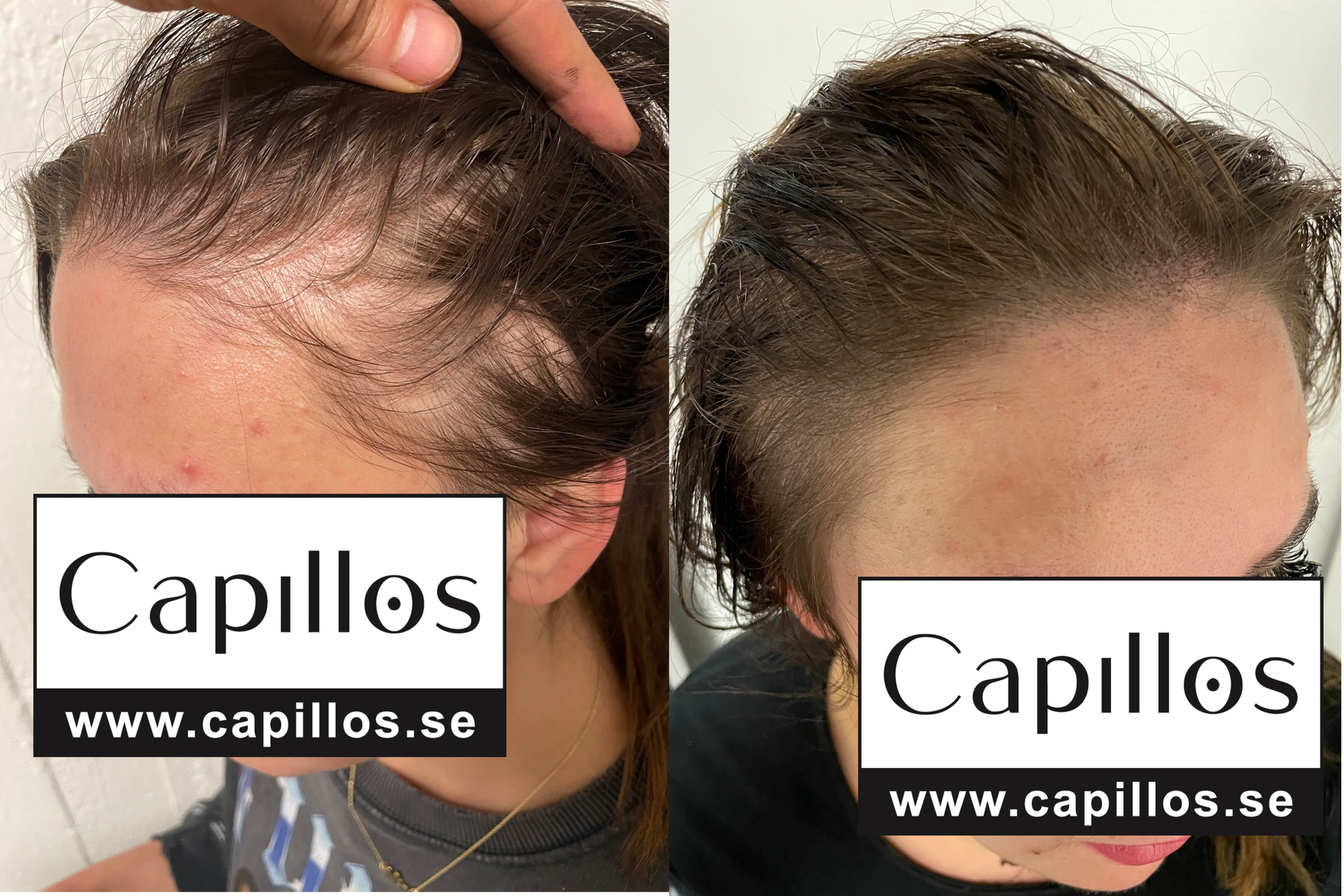 Kvinnligt håravfall - Scalp Micropigmentation Capillos - Margareta
