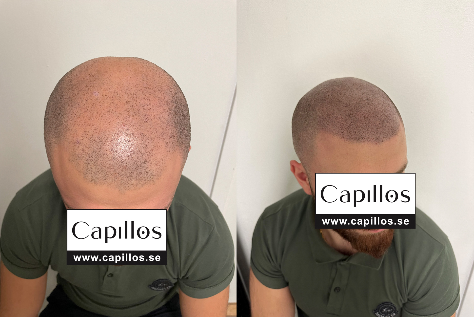 Skalp Pigmentering - Scalp Micropigmentation Capillos - Melke