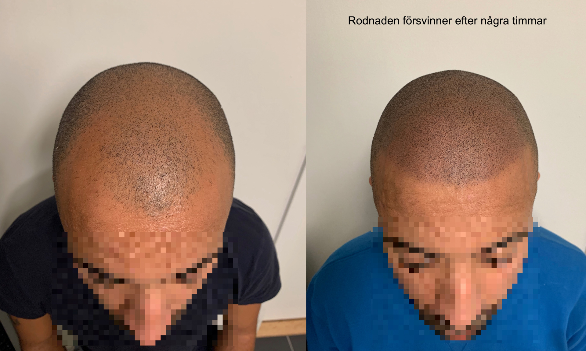 Bakåtkrypande hårlinje - Scalp Micropigmentation Capillos - Bästa hjälp med bakåtkrypande hårlinje Stockholm Göteborg Malmö Sverige --