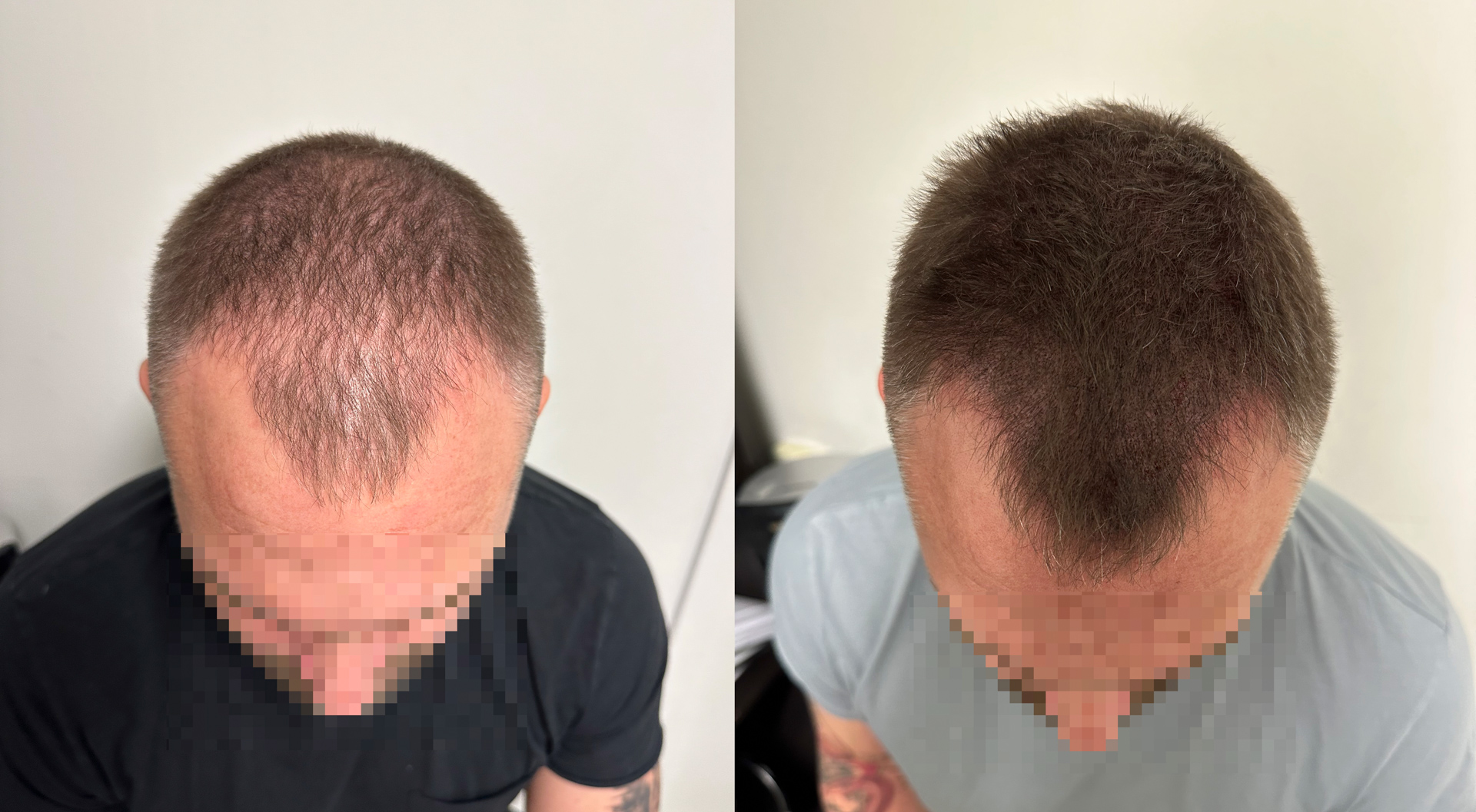 Bakåtkrypande hårlinje - Scalp Micropigmentation Capillos - Bästa hjälp med bakåtkrypande hårlinje Stockholm Göteborg Malmö Sverige - -1