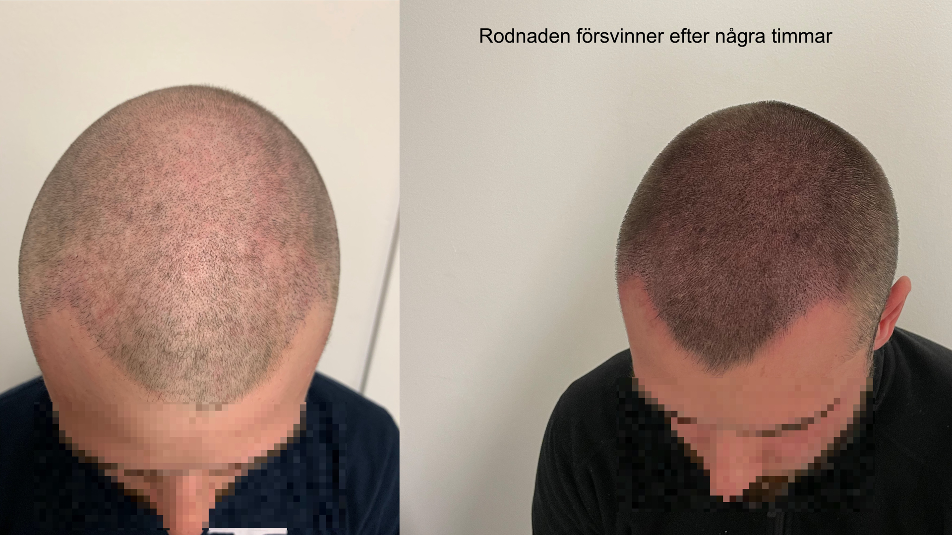Högt hårfäste behandling - Scalp Micropigmentation Capillos - Bästa högt hårfäste behandling Stockholm Göteborg Malmö Sverige - 001