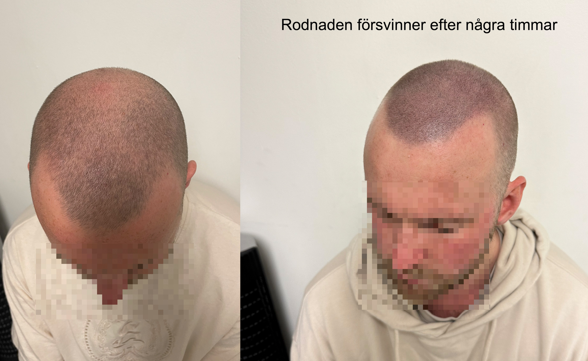 Högt hårfäste behandling - Scalp Micropigmentation Capillos - Bästa högt hårfäste behandling Stockholm Göteborg Malmö Sverige - 002