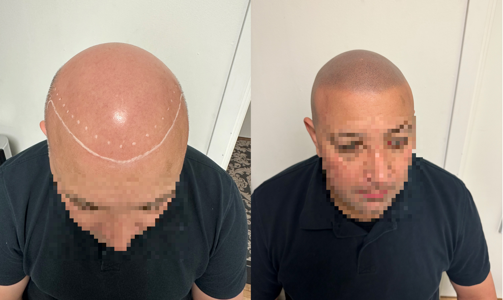 Scalp micropigmentation - Scalp Micropigmentation Capillos - Bästa scalp micropigmentation Stockholm Göteborg Malmö Sverige - 002