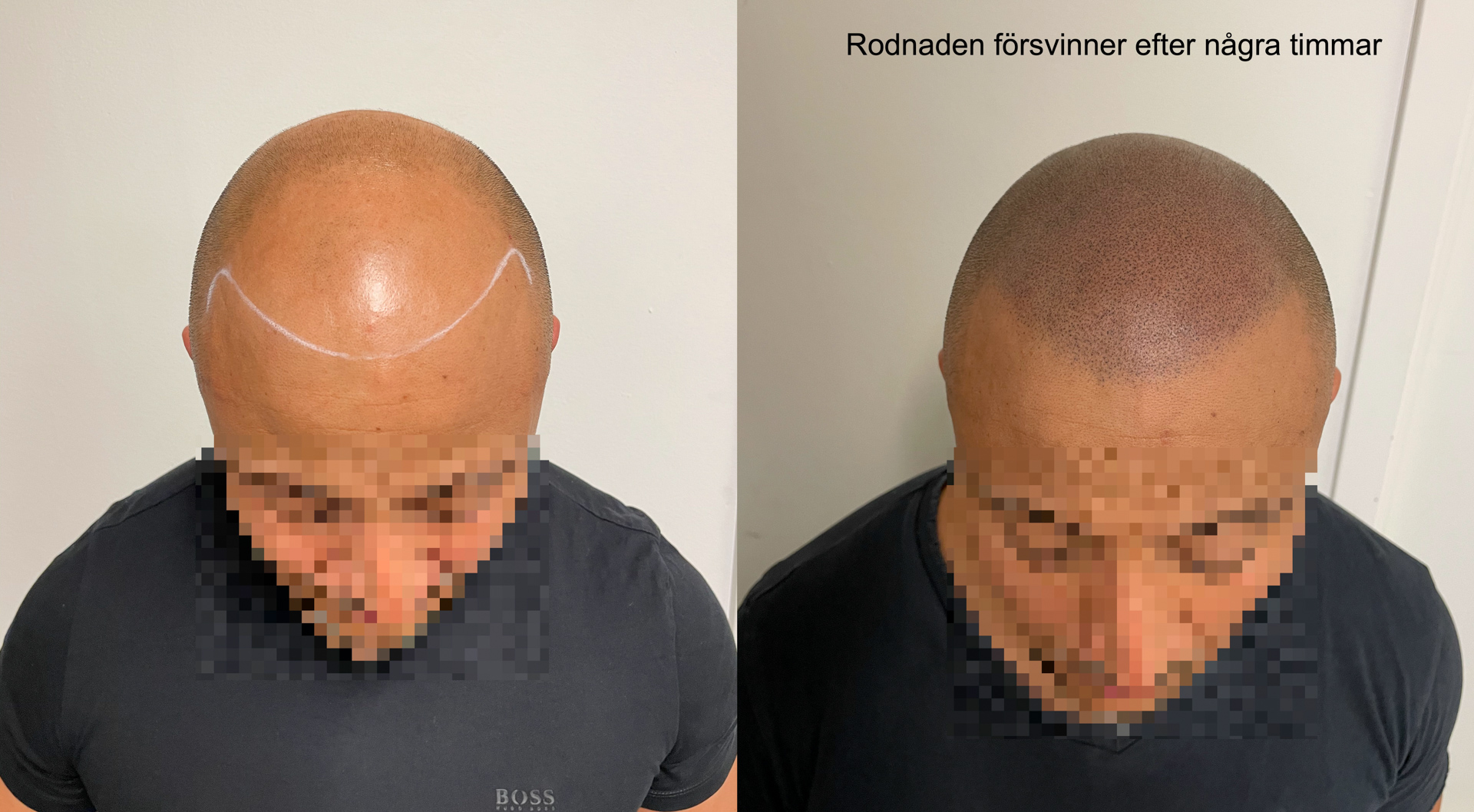 Skalp pigmentering - Scalp Micropigmentation Capillos - Bästa skalp pigmentering behandling Stockholm Göteborg Malmö Sverige - 001