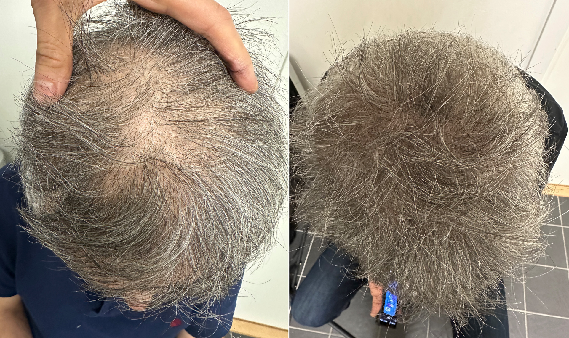 Skalp pigmentering - Scalp Micropigmentation Capillos - Bästa skalp pigmentering behandling Stockholm Göteborg Malmö Sverige - 002