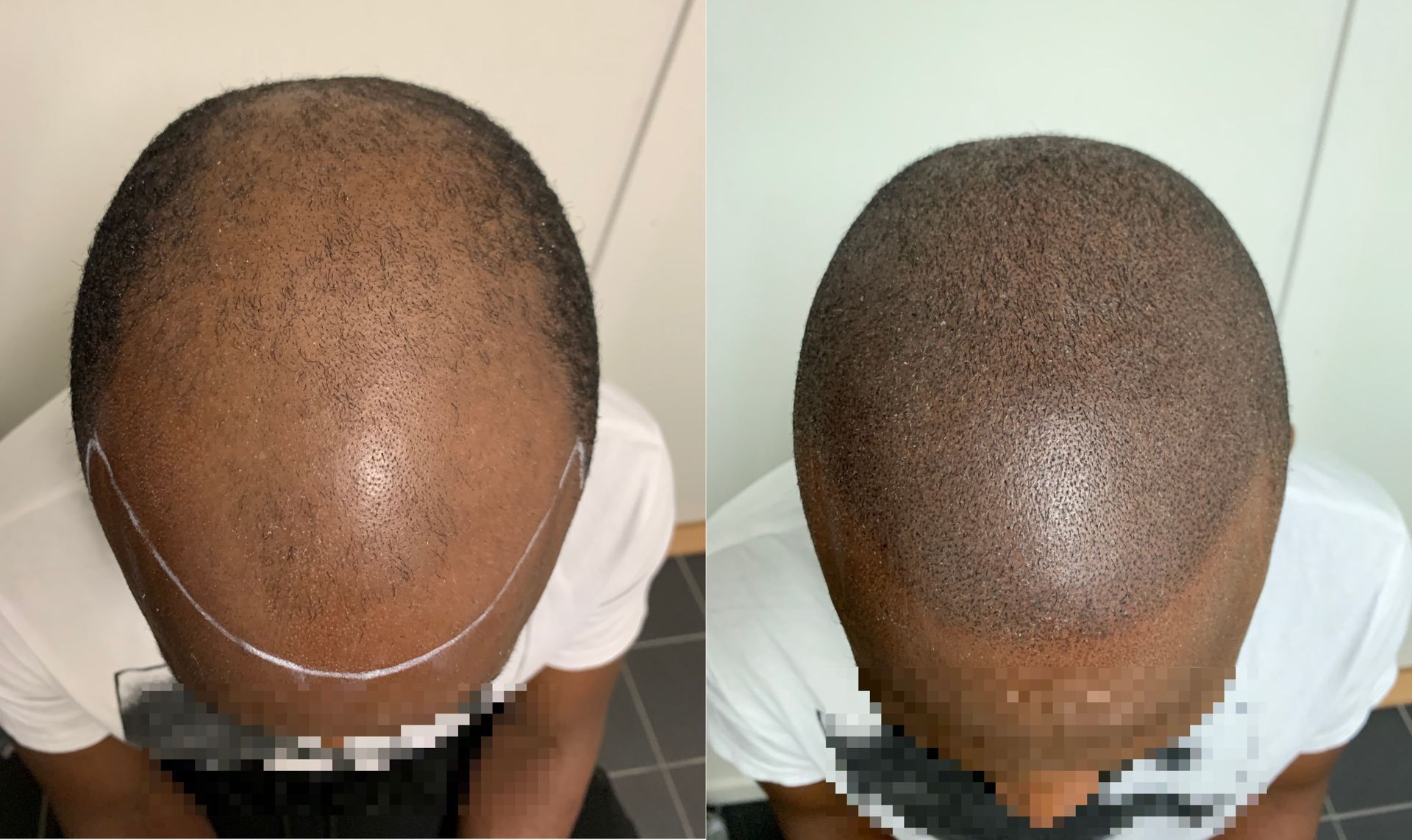 SMP - Scalp Micropigmentation Capillos - Bästa SMP behandling Stockholm Göteborg Malmö Sverige - 002