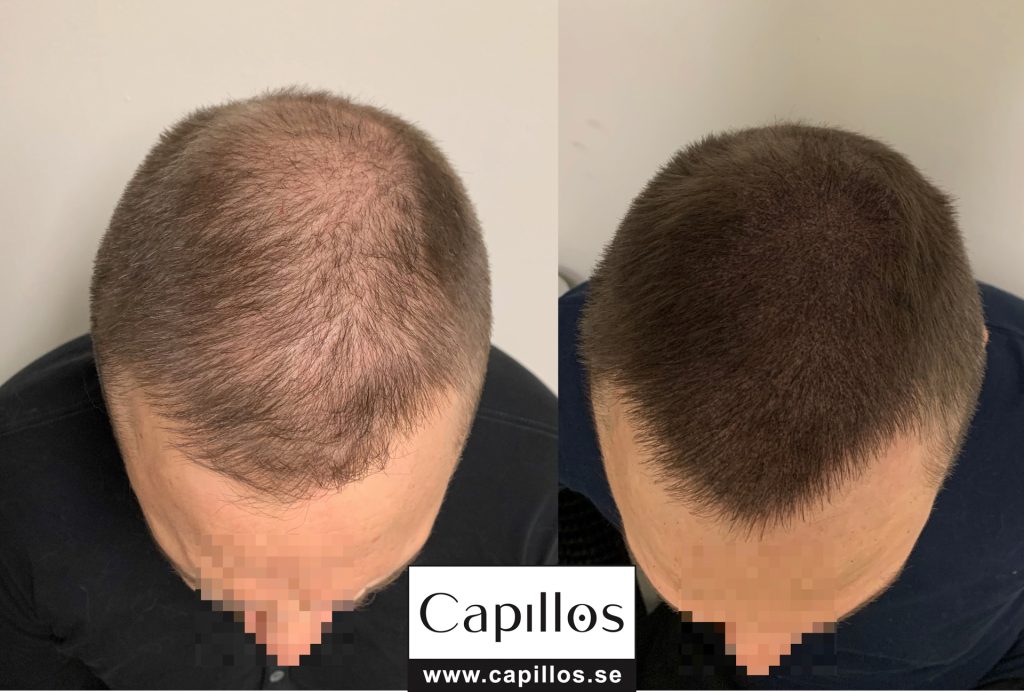 Tappar hår - Scalp Micropigmentation Capillos - Bästa tappar hår behandling Stockholm Göteborg Malmö Sverige - 001